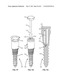 LOW PROFILE SPINAL PROSTHESIS INCORPORATING A BONE ANCHOR HAVING A     DEFLECTABLE POST AND A COMPOUND SPINAL ROD diagram and image