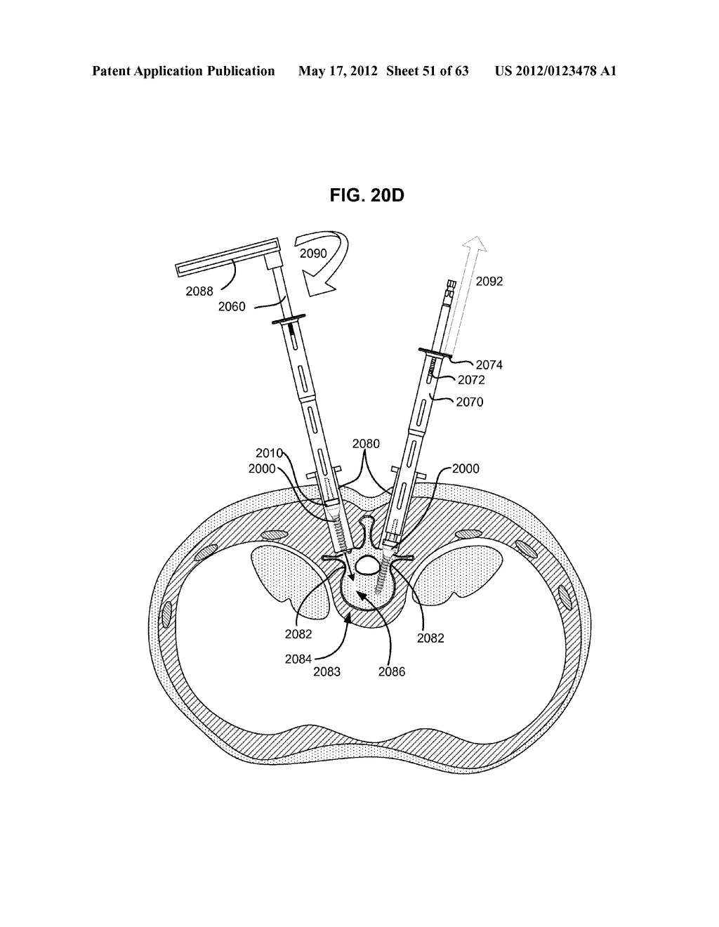 LOW PROFILE SPINAL PROSTHESIS INCORPORATING A BONE ANCHOR HAVING A     DEFLECTABLE POST AND A COMPOUND SPINAL ROD - diagram, schematic, and image 52