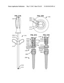 LOW PROFILE SPINAL PROSTHESIS INCORPORATING A BONE ANCHOR HAVING A     DEFLECTABLE POST AND A COMPOUND SPINAL ROD diagram and image