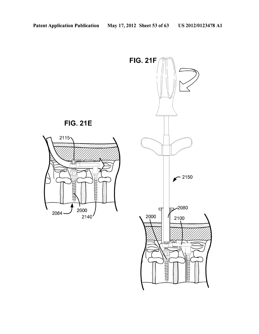 LOW PROFILE SPINAL PROSTHESIS INCORPORATING A BONE ANCHOR HAVING A     DEFLECTABLE POST AND A COMPOUND SPINAL ROD - diagram, schematic, and image 54