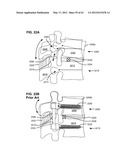 LOW PROFILE SPINAL PROSTHESIS INCORPORATING A BONE ANCHOR HAVING A     DEFLECTABLE POST AND A COMPOUND SPINAL ROD diagram and image