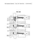 LOW PROFILE SPINAL PROSTHESIS INCORPORATING A BONE ANCHOR HAVING A     DEFLECTABLE POST AND A COMPOUND SPINAL ROD diagram and image