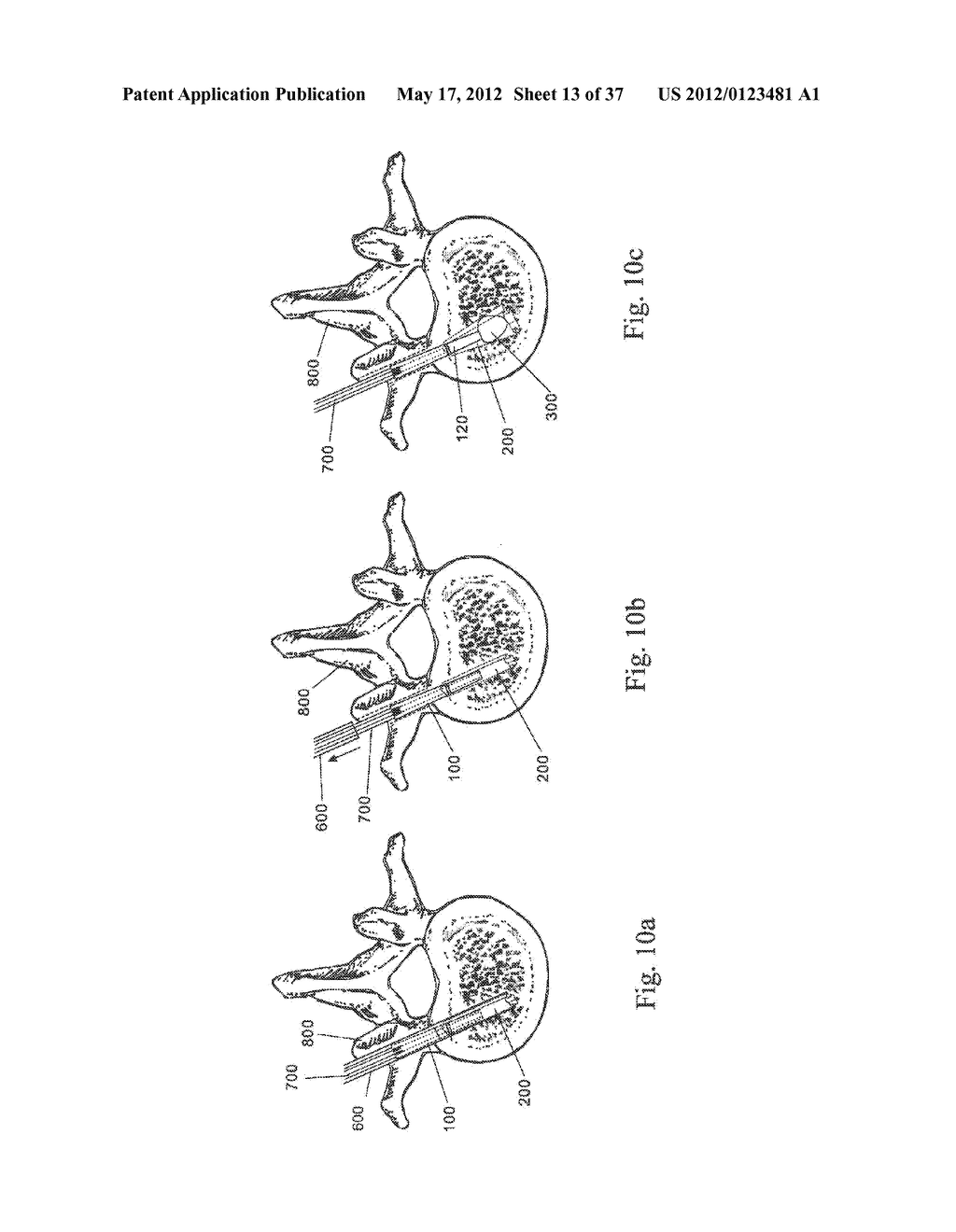 BONE FIXATION DEVICE - diagram, schematic, and image 14