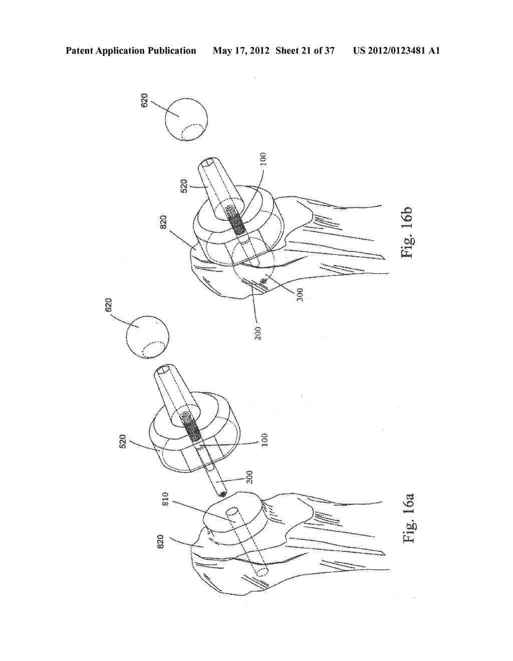 BONE FIXATION DEVICE - diagram, schematic, and image 22