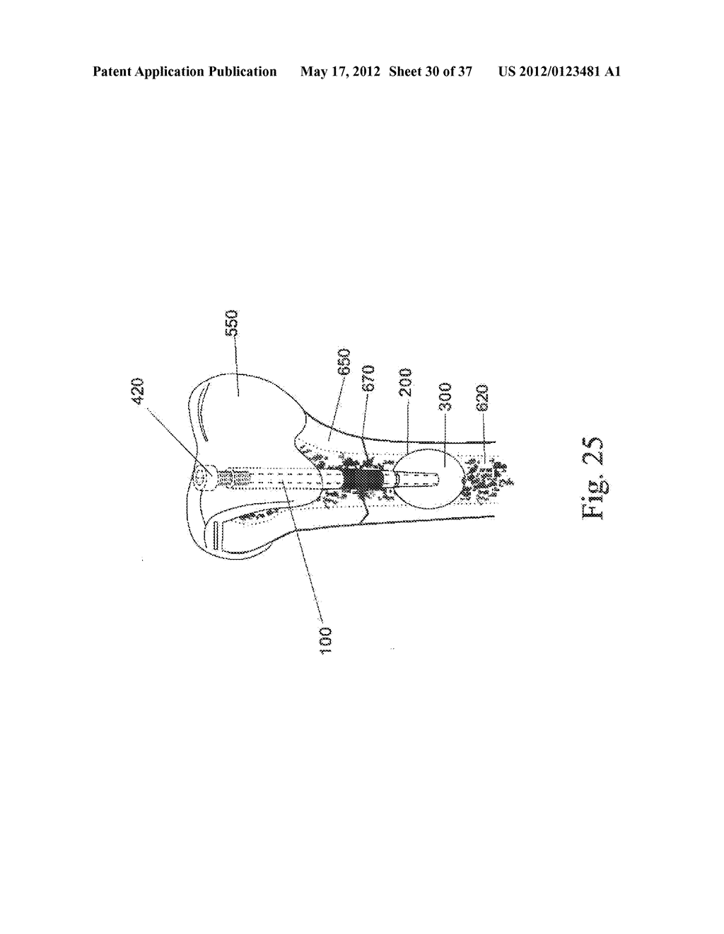 BONE FIXATION DEVICE - diagram, schematic, and image 31