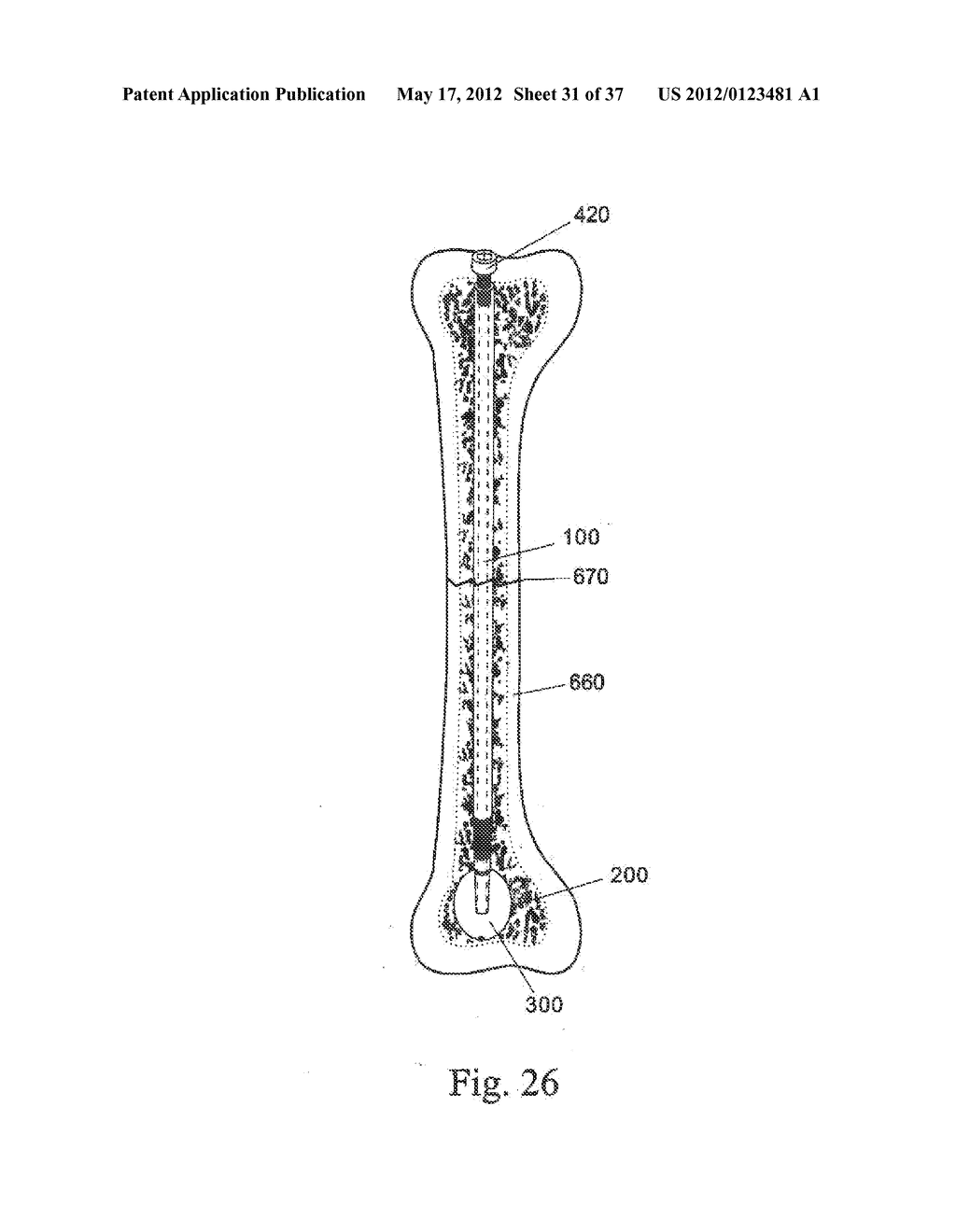 BONE FIXATION DEVICE - diagram, schematic, and image 32