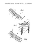 METHOD FOR PLACEMENT OF A PEDICLE SCREW AND ROD SYSTEM diagram and image