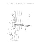 Ulna Osteotomy System diagram and image