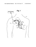 CONNECTIVITY DETECTION AND TYPE IDENTIFICATION OF AN IMPLANTED LEAD FOR AN     IMPLANTABLE MEDICAL DEVICE diagram and image