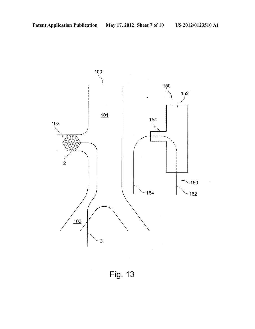 METHOD OF POSITIONING A TUBULAR ELEMENT IN A BLOOD VESSEL OF A PERSON - diagram, schematic, and image 08