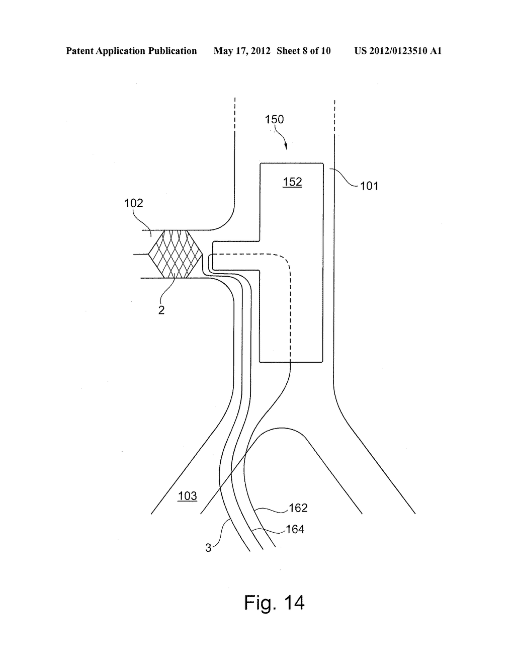 METHOD OF POSITIONING A TUBULAR ELEMENT IN A BLOOD VESSEL OF A PERSON - diagram, schematic, and image 09