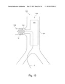 METHOD OF POSITIONING A TUBULAR ELEMENT IN A BLOOD VESSEL OF A PERSON diagram and image