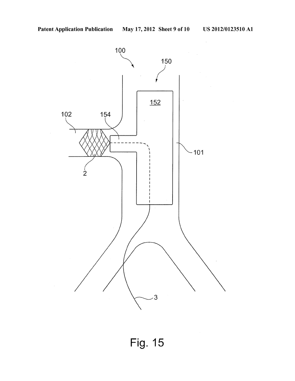 METHOD OF POSITIONING A TUBULAR ELEMENT IN A BLOOD VESSEL OF A PERSON - diagram, schematic, and image 10