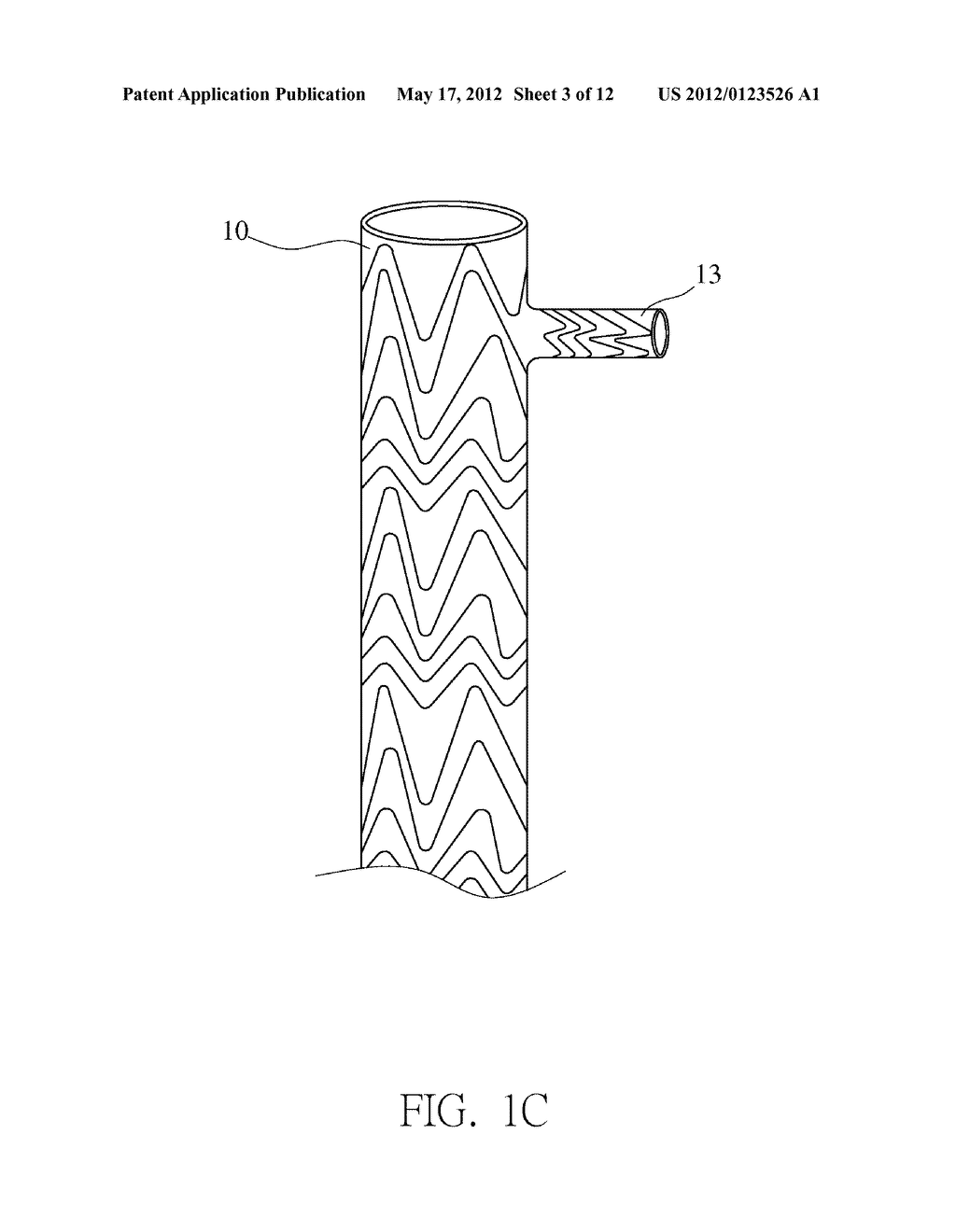 THORACIC AORTIC STENT STRUCTURE - diagram, schematic, and image 04