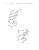 Intervertebral Spacer and Method of Installation Thereof diagram and image