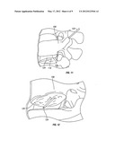 Intervertebral Spacer and Method of Installation Thereof diagram and image