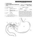 PYLORIC OBESITY VALVE diagram and image