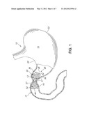 PYLORIC OBESITY VALVE diagram and image