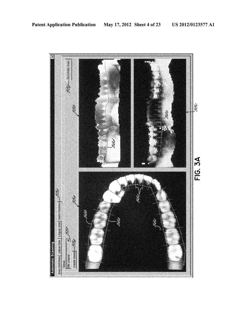 CUSTOM ORTHODONTIC APPLIANCE FORMING METHOD AND APPARATUS - diagram, schematic, and image 05