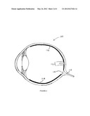 METHOD AND SYSTEM FOR TREATING BINOCULAR ANOMALIES diagram and image