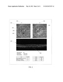 3D RETINAL DISRUPTIONS DETECTION USING OPTICAL COHERENCE TOMOGRAPHY diagram and image