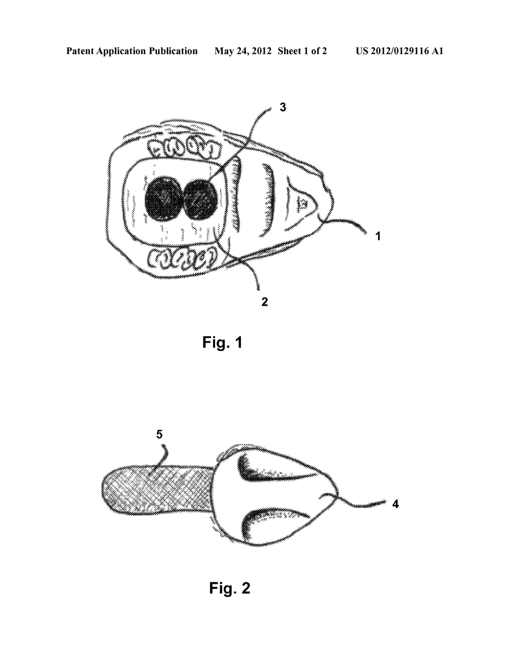 Removable Rodent Intraoral Device - diagram, schematic, and image 02