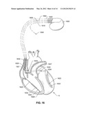 IMPLANTABLE MICRO-ELECTROMECHANICAL SYSTEM SENSOR diagram and image