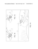 RETROGRADE ENTRY ANTEGRADE PLACEMENT FOR FEMORAL ARTERY ACCESS diagram and image