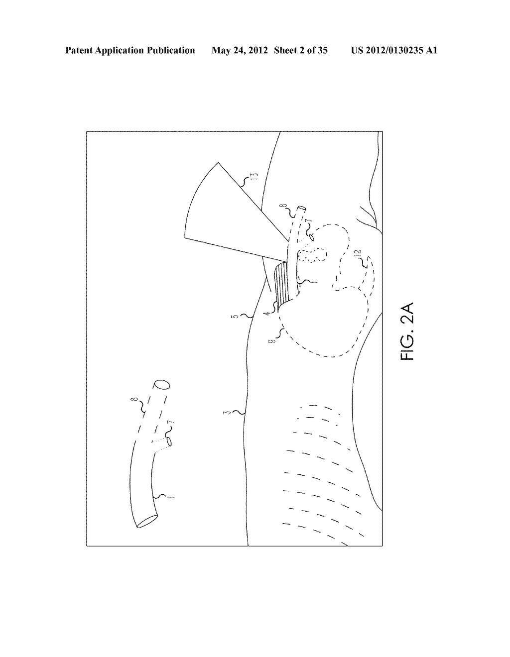 RETROGRADE ENTRY ANTEGRADE PLACEMENT FOR FEMORAL ARTERY ACCESS - diagram, schematic, and image 03