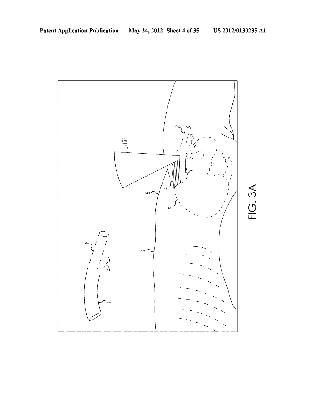 RETROGRADE ENTRY ANTEGRADE PLACEMENT FOR FEMORAL ARTERY ACCESS - diagram, schematic, and image 05