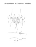 RETROGRADE ENTRY ANTEGRADE PLACEMENT FOR FEMORAL ARTERY ACCESS diagram and image