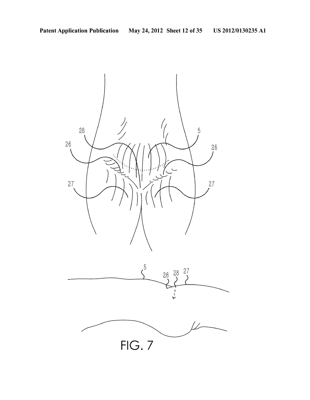 RETROGRADE ENTRY ANTEGRADE PLACEMENT FOR FEMORAL ARTERY ACCESS - diagram, schematic, and image 13