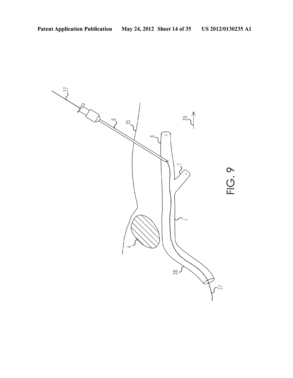 RETROGRADE ENTRY ANTEGRADE PLACEMENT FOR FEMORAL ARTERY ACCESS - diagram, schematic, and image 15