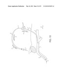 RETROGRADE ENTRY ANTEGRADE PLACEMENT FOR FEMORAL ARTERY ACCESS diagram and image