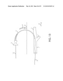 RETROGRADE ENTRY ANTEGRADE PLACEMENT FOR FEMORAL ARTERY ACCESS diagram and image