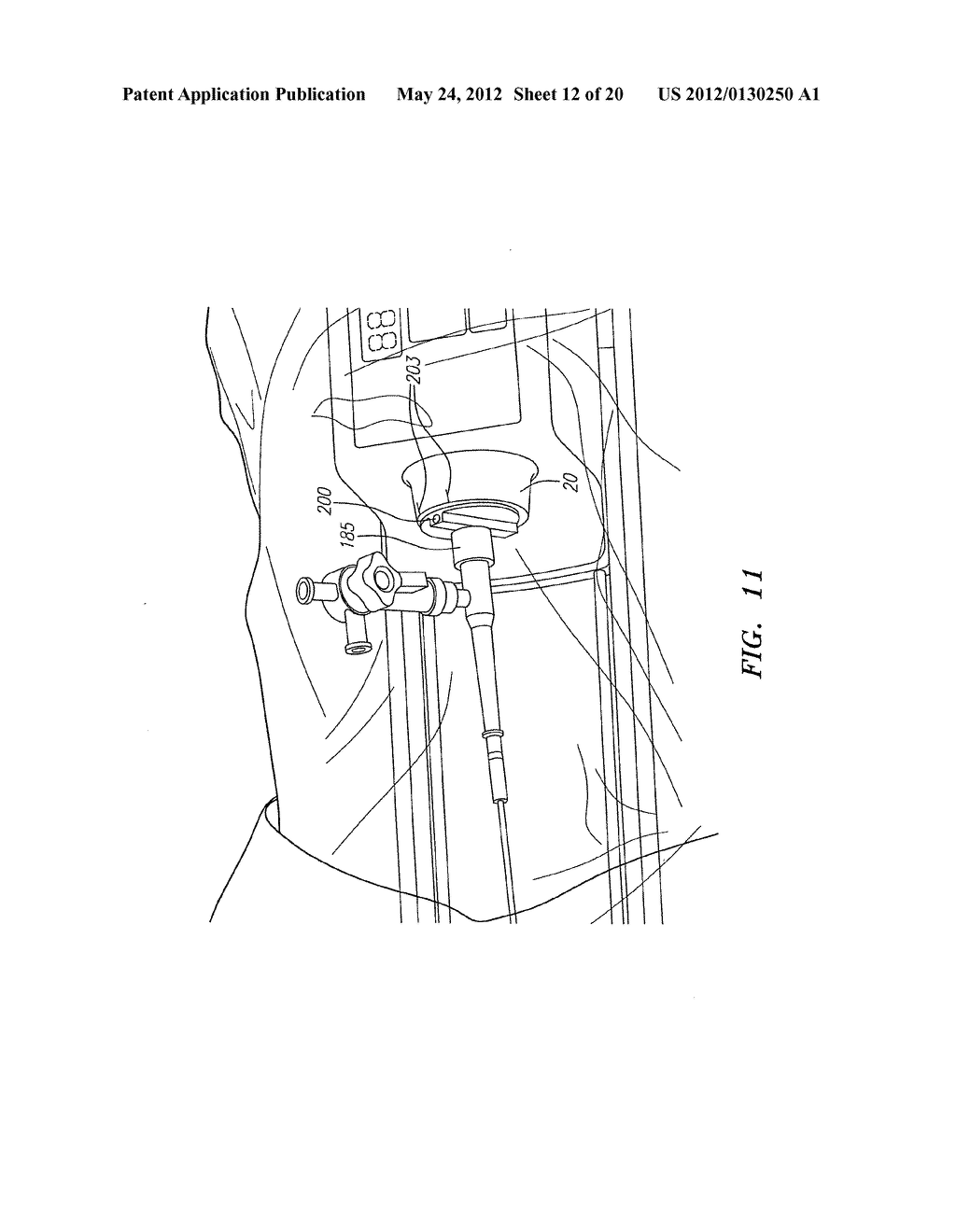 Pleated Bag for Interventional Pullback Systems - diagram, schematic, and image 13