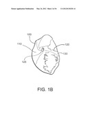 DEVICES, SYSTEMS, AND METHODS FOR MYOCARDIAL INFARCT BORDER ZONE     REINFORCEMENT diagram and image