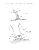 DEVICES, SYSTEMS, AND METHODS FOR MYOCARDIAL INFARCT BORDER ZONE     REINFORCEMENT diagram and image