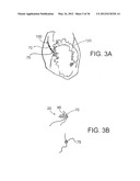 DEVICES, SYSTEMS, AND METHODS FOR MYOCARDIAL INFARCT BORDER ZONE     REINFORCEMENT diagram and image