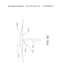 DEVICES, SYSTEMS, AND METHODS FOR MYOCARDIAL INFARCT BORDER ZONE     REINFORCEMENT diagram and image