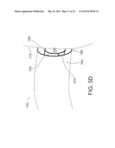 DEVICES, SYSTEMS, AND METHODS FOR MYOCARDIAL INFARCT BORDER ZONE     REINFORCEMENT diagram and image