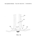 DEVICES, SYSTEMS, AND METHODS FOR MYOCARDIAL INFARCT BORDER ZONE     REINFORCEMENT diagram and image