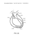 DEVICES, SYSTEMS, AND METHODS FOR MYOCARDIAL INFARCT BORDER ZONE     REINFORCEMENT diagram and image