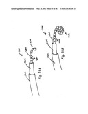 DEVICES, SYSTEMS, AND METHODS FOR MYOCARDIAL INFARCT BORDER ZONE     REINFORCEMENT diagram and image