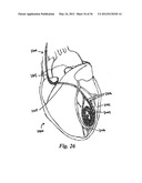 DEVICES, SYSTEMS, AND METHODS FOR MYOCARDIAL INFARCT BORDER ZONE     REINFORCEMENT diagram and image