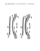 DEVICES, SYSTEMS, AND METHODS FOR MYOCARDIAL INFARCT BORDER ZONE     REINFORCEMENT diagram and image