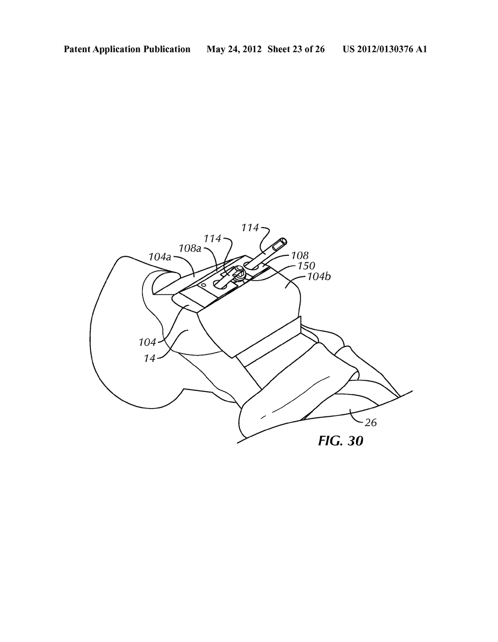 SURGICAL INSTRUMENTATION AND METHODS OF USE FOR IMPLANTING A PROSTHESIS - diagram, schematic, and image 24