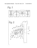 METHOD OF PERFORMING OSTEOTOMY diagram and image