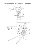 METHOD OF PERFORMING OSTEOTOMY diagram and image