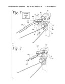 METHOD OF PERFORMING OSTEOTOMY diagram and image